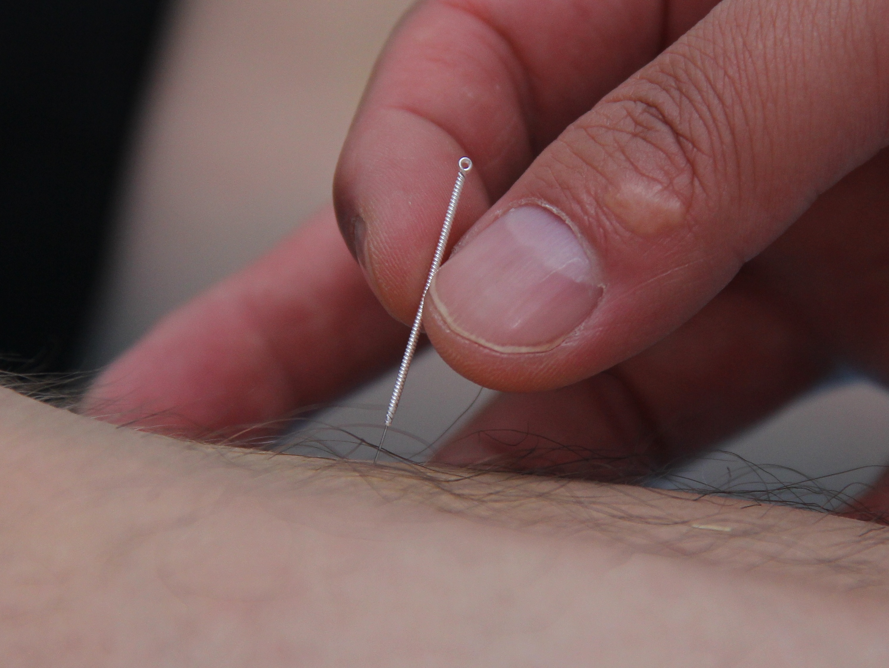 新乡潘剑中医，潘剑医生针灸图